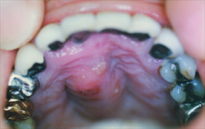 口蓋膿瘍
