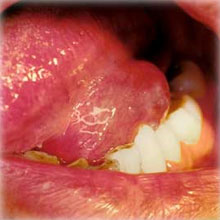 舌の下のできもの（ガマ腫）