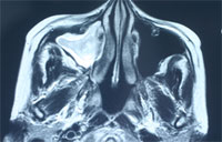 術後性上顎嚢胞画像