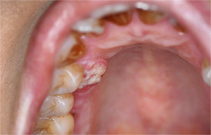 上顎歯肉癌（じょうがくしにくがん）
