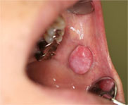 お口の中のできもの（腫瘍）画像