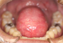 舌下に発生した巨大な嚢胞